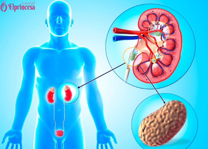كيفية تفتيت حصى الكلى بالأعشاب